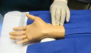 Radial artery cannulation. Palpation of radial art