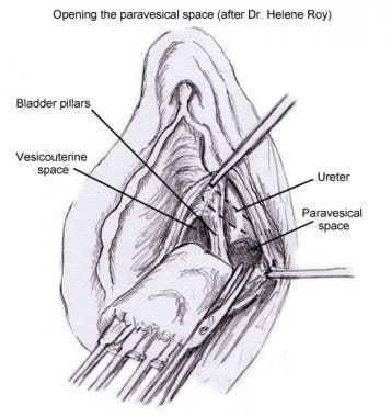 图4(图8):膀胱旁间隙的定义