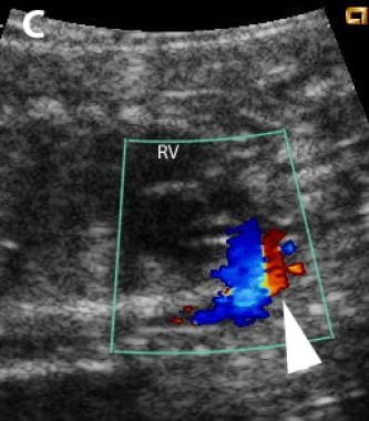 胎儿的矢状断面图像与重度主动脉瓣stenosi