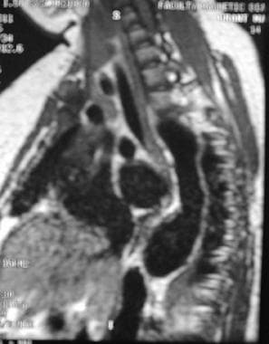 MRI of thorax of 15-year-old adolescent girl with 
