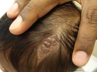 Nevus sebaceus in a 4-month-old baby manifesting a