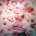 Acne Conglobata