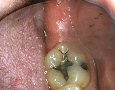 Oral frictional hyperkeratosis of the retromolar p