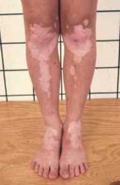 Progressive vitiligo in a patient with Nijmegen br