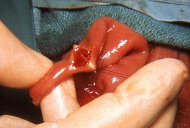 Intestinal obstruction in the newborn. Jejunal obs