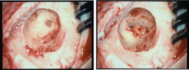 Intraoperative image of a left ear in the surgical
