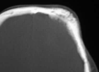 Case 2: Bone-window CT scan reveals the skull invo