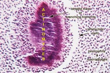 Actinomyces israelii. (The image is labeled.) 