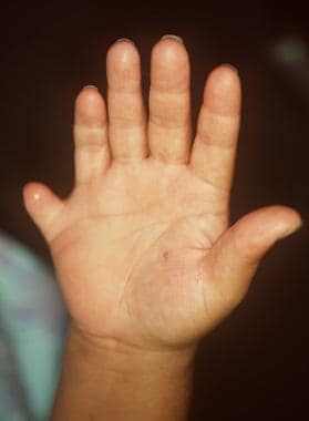Polydactyly seen in Bardet-Biedl syndrome (associa
