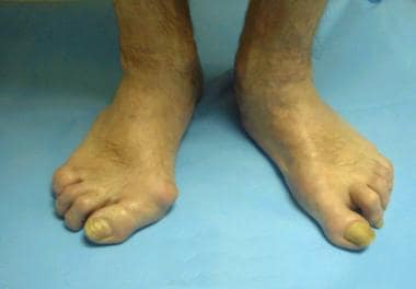 Z Foot Deformity