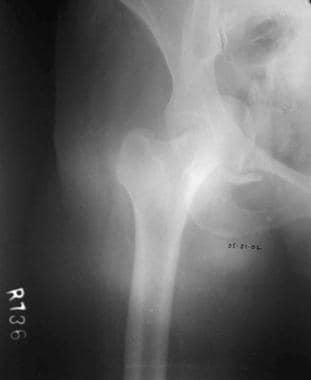 Anterior wall fracture. 