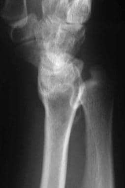 Postoperative lateral radiograph of the wrist of p