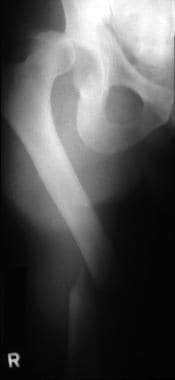 Midshaft femoral fracture with associated ipsilate