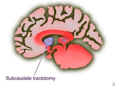 Subcaudate tractotomy. The position of the lesion 