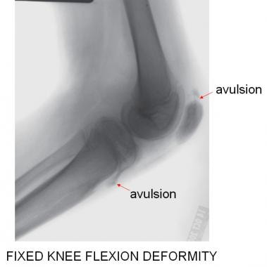 Flexion and extension of leg Black and White Stock Photos & Images