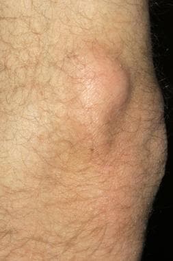 Calcinosis cutis over the left elbow in a patient 