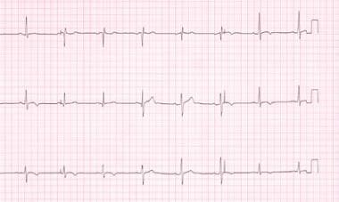 st segment elevation pericarditis