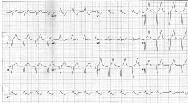 Pacemaker Syndrome. Accelerated idioventricular rh