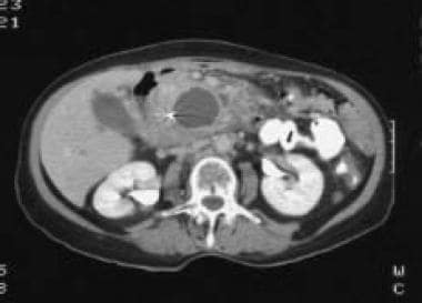 Chronic pancreatitis. Abdominal CT scan showing  a