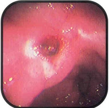 Upper gastrointestinal bleeding (UGIB). Ulcer with
