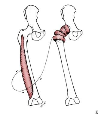 Illustrated is Girdlestone arthroplasty for femora
