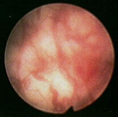 Cystoscopic view of a bladder showing the neovascu