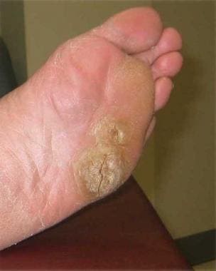 papillomavirus feet
