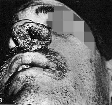 Granulomatous lesion involving the nose in patient