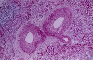 Nephrosclerosis. Fibrointimal proliferation of the