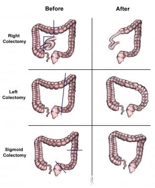 结肠腺癌的标准结肠切除术