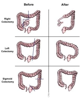 Standard colectomies for adenocarcinoma of the col