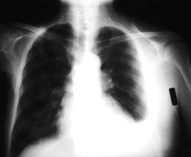 Isolated, left-sided pleural effusion with visuali