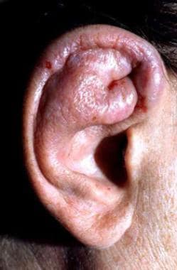 Severe auricular edema and inflammation. Courtesy 