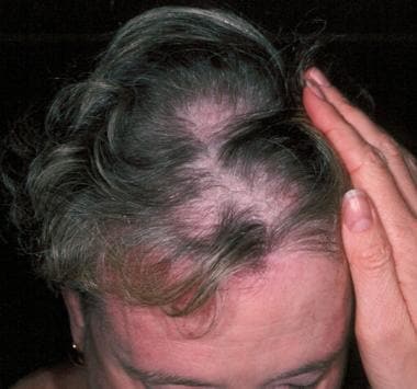 Diffuse alopecia with scaly scalp dermatosis is co