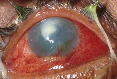 Severe chemical injury with early corneal neovascu