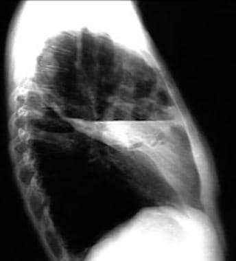 Lateral chest radiograph shows air-fluid level cha