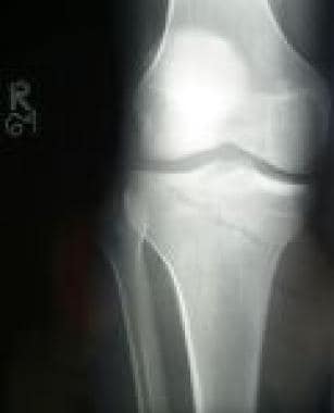 Shown is an intra-articular fracture of the medial
