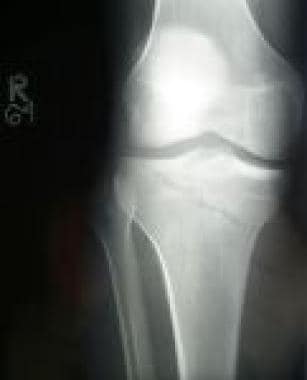 distal tibia fibula fracture