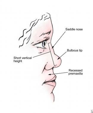 saddle nose