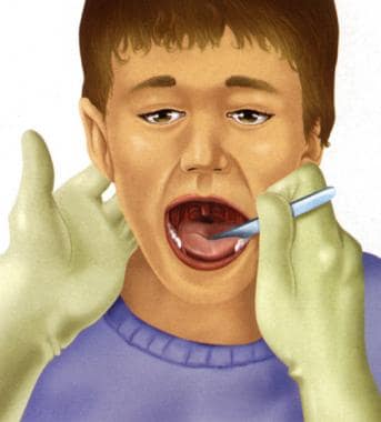 Examination of the tonsils and pharynx. 