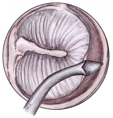 Stapedotomy Animation to Treat Otosclerosis (Curable Type of