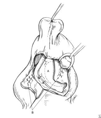 Surgical aspects of septal perforation. Bilateral 