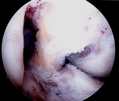 An additional view of the posterior cruciate ligam