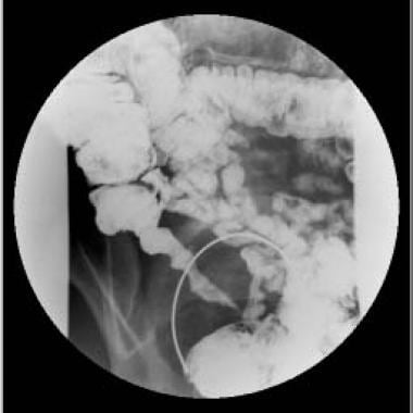 Image obtained during upper gastrointestinal serie