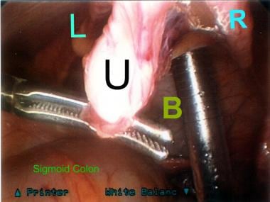 Laparoscopic removal of urachal cyst (U). L indica