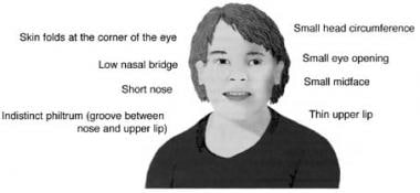 Facial characteristics of a child with fetal alcoh