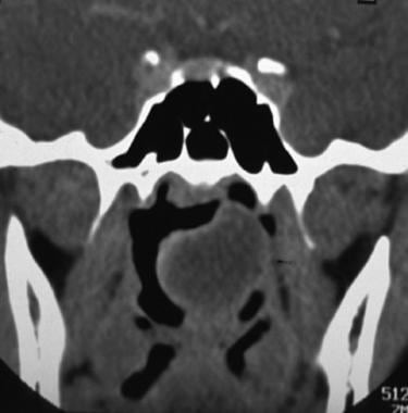 Coronal CT scan section through the posterior naso