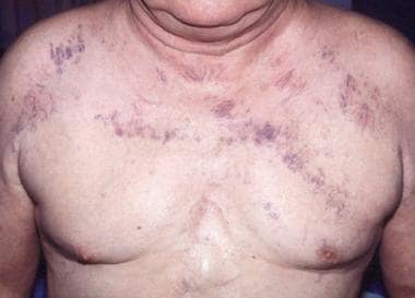 Superior vena cava syndrome in a 63-year-old man w
