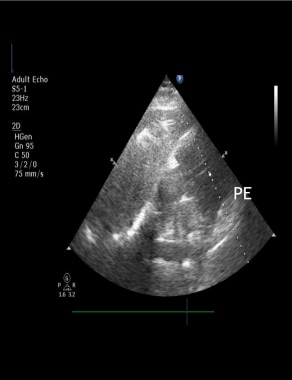 Intraoperative transesophageal echocardiogram demo