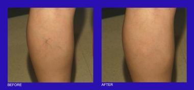 Telangiectasia on the calf before and after intens